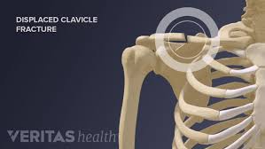 fracture cause of injury